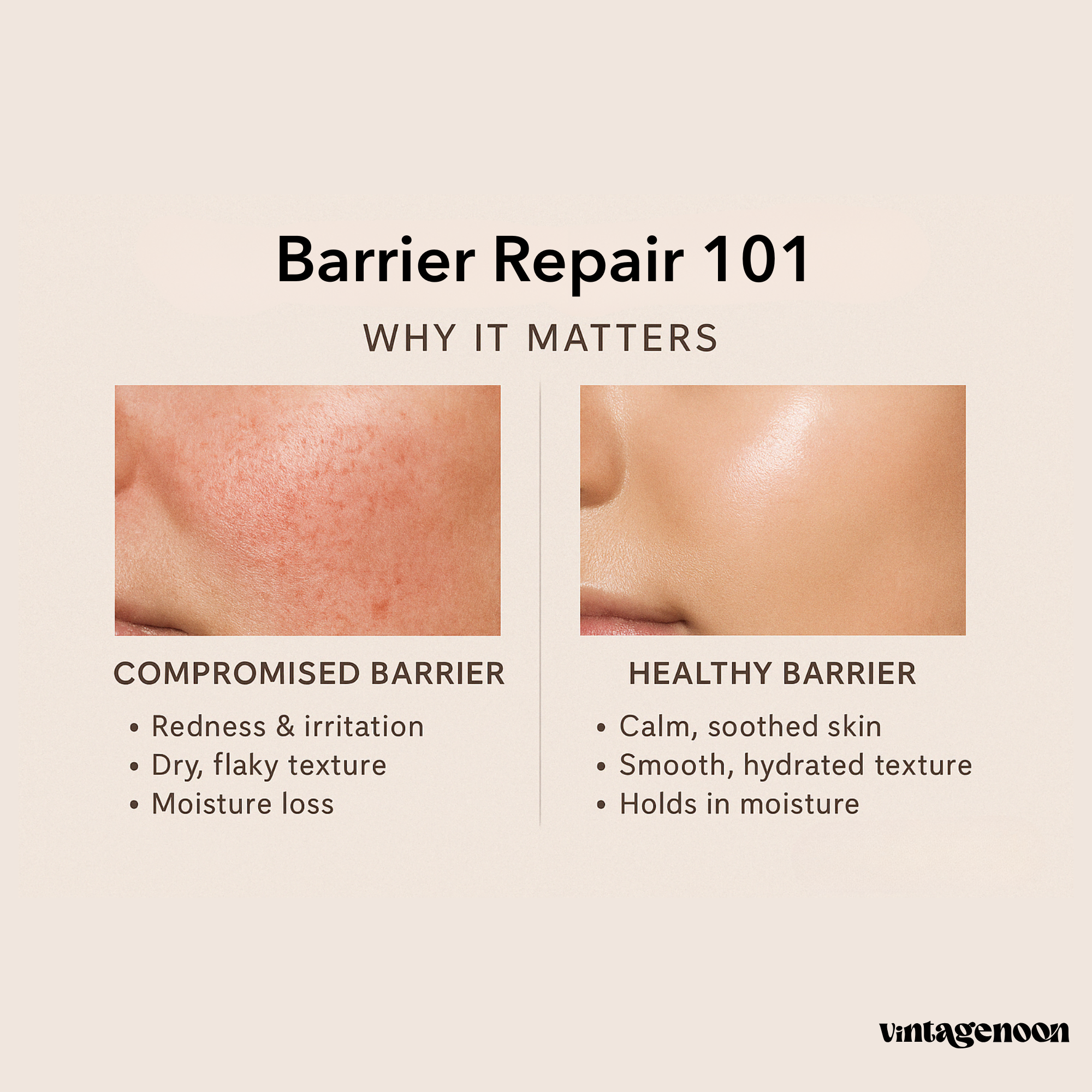 Why Barrier Repair Is Essential for Sensitive Skin